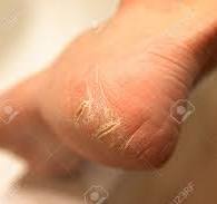TALONS CRAQUELES